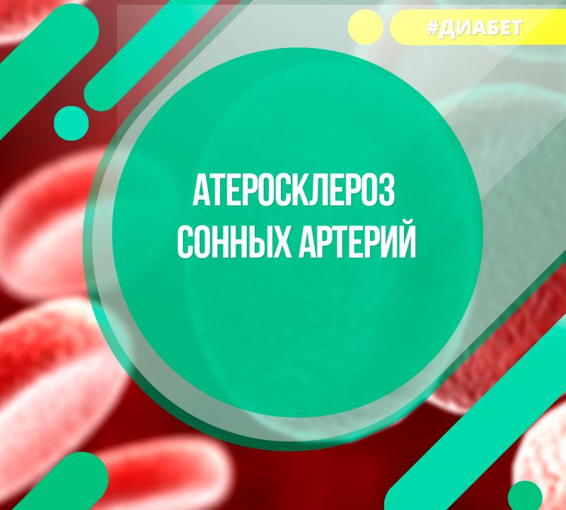 Атеросклероз сонных артерий