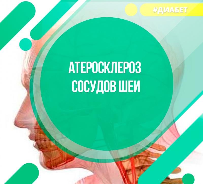 Атеросклероз сосудов шеи